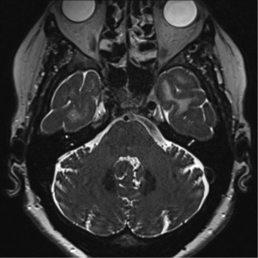 Anterior temporal pole cysts (Radiopaedia 46629-51102 Axial 10).png