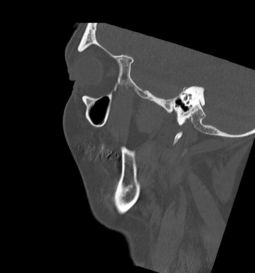 Anterior temporomandibular joint dislocation (Radiopaedia 59430-66784 B 50).jpg