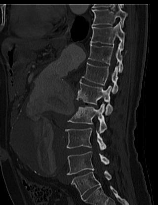 File:Anterior vertebral scalloping (abdominal aortic aneurysm) (Radiopaedia 66744-76067 Sagittal bone window 47).jpg