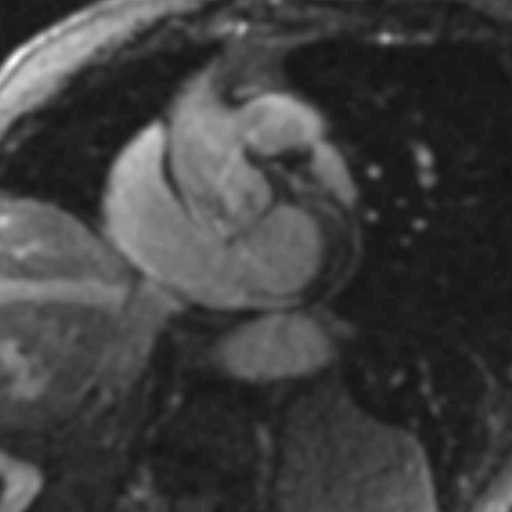 File:Anteroseptal hypokinesia after myocardial infarction (Radiopaedia 15978-15633 I 1).jpg