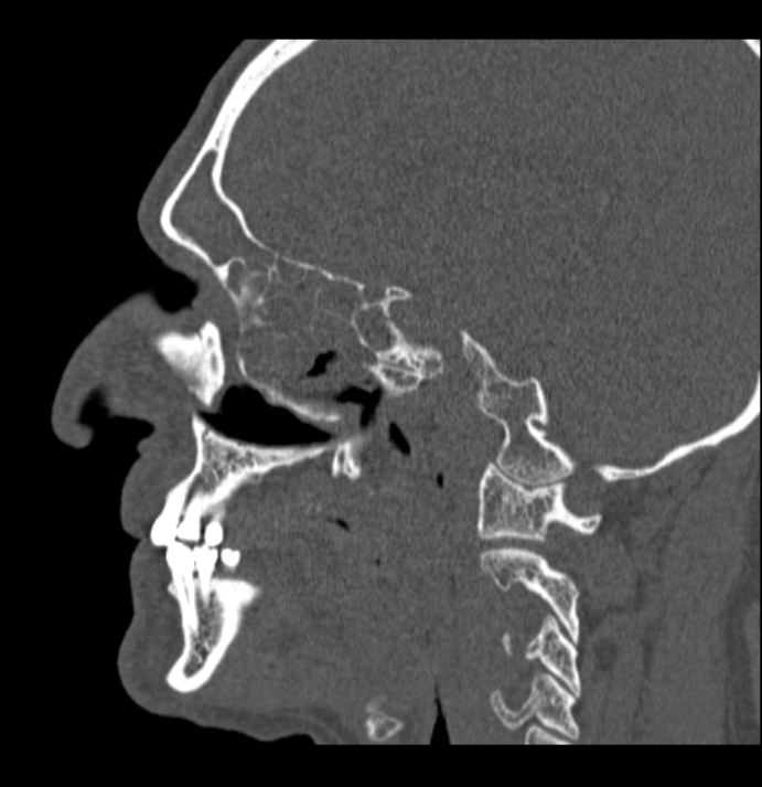 Antrochoanal polyp (Radiopaedia 79011-92169 Sagittal bone window 45).jpg