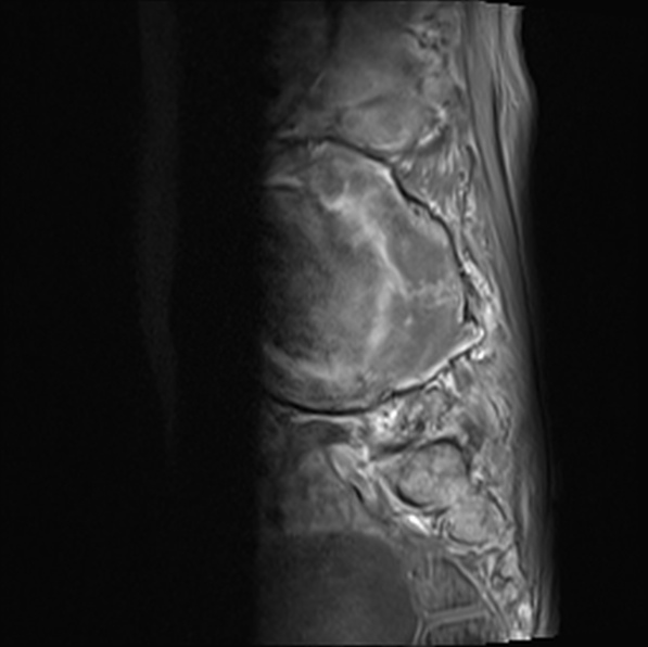 File:Aortic aneurysm with spinal destruction (Radiopaedia 42301-45409 Sagittal T1 fat sat 18).jpg