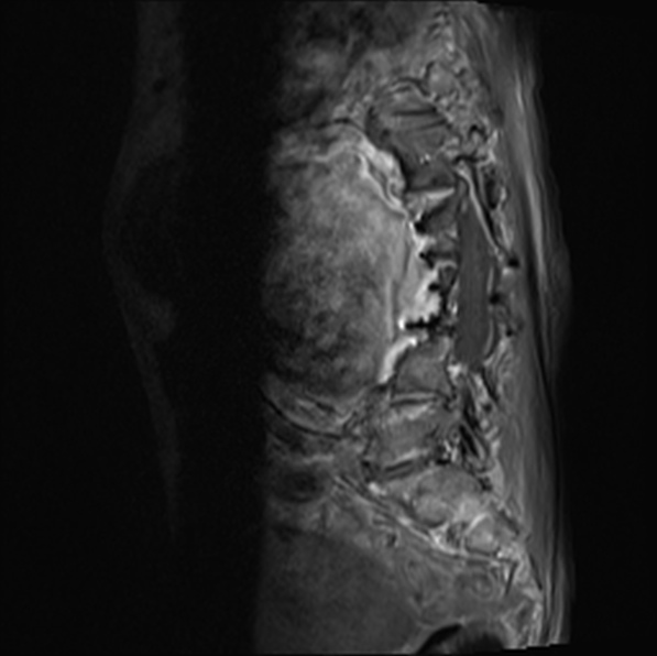 File:Aortic aneurysm with spinal destruction (Radiopaedia 42301-45409 Sagittal T1 fat sat 29).jpg