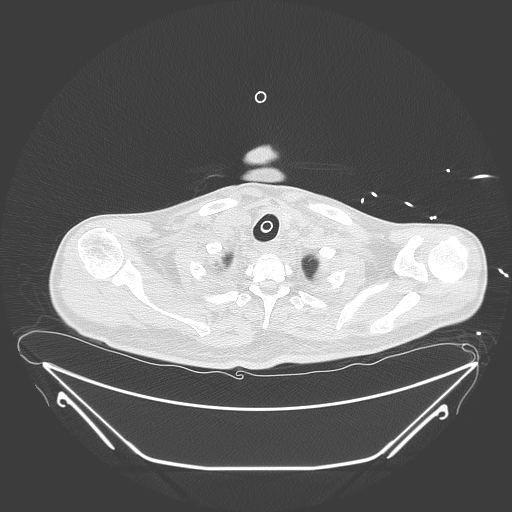 Aortic arch aneurysm (Radiopaedia 84109-99365 Axial lung window 40).jpg