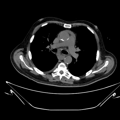 Aortic arch aneurysm (Radiopaedia 84109-99365 Axial non-contrast 122).jpg