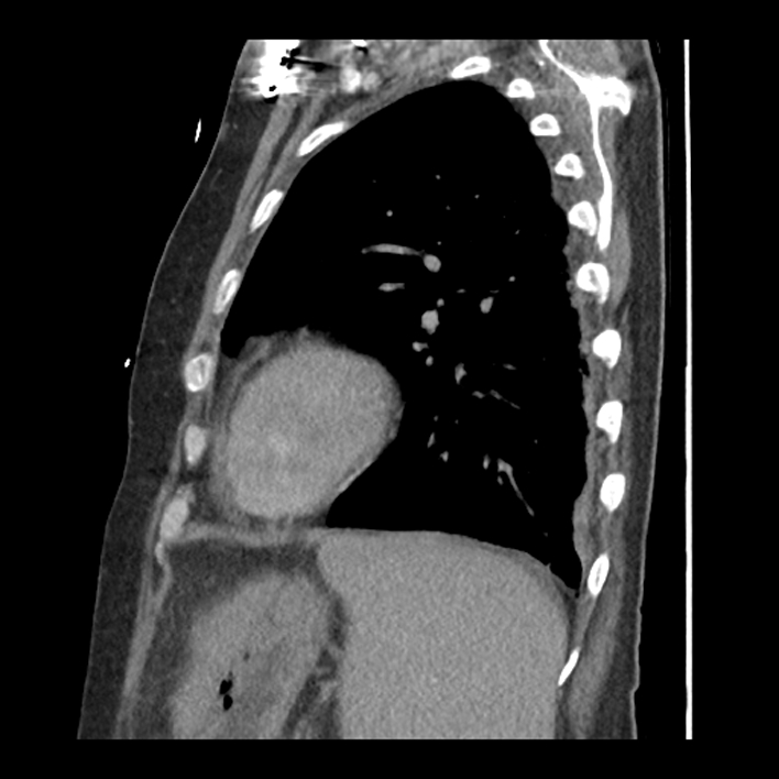 Aortic arch graft infection (FDG PET-CT) (Radiopaedia 71975-82437 C 52).jpg