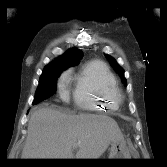 Aortic arch graft infection (FDG PET-CT) (Radiopaedia 71975-82437 Coronal 16).jpg