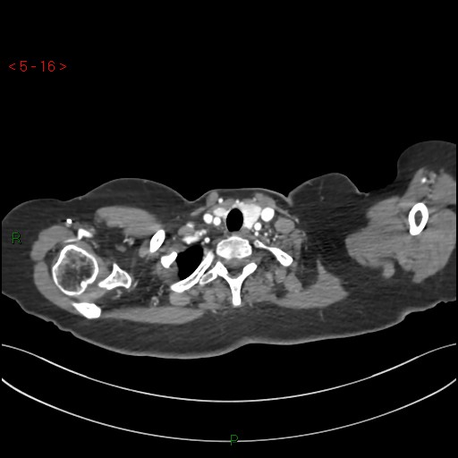 File:Aortic arch origin of left vertebral artery (Radiopaedia 51520-57286 A 15).jpg