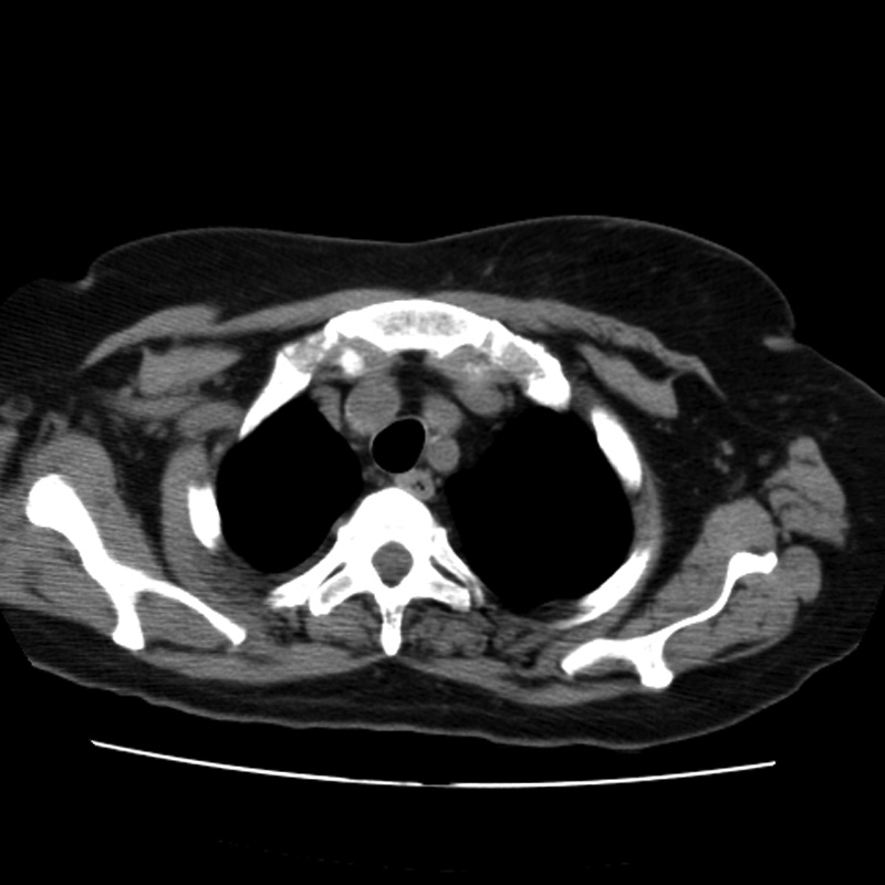 Aortic arch pseudoaneurysm (Radiopaedia 8534-9368 Axial non-contrast 8).jpg