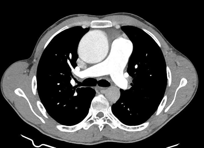 File:Aortic coarctation with aneurysm (Radiopaedia 74818-85828 A 126).jpg