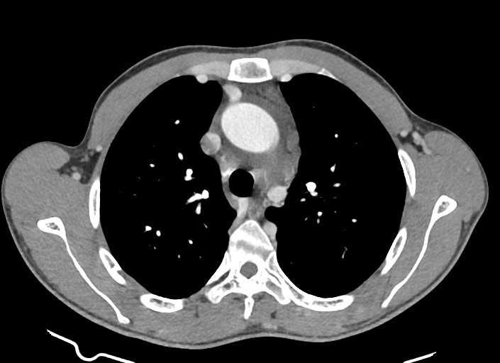 File:Aortic coarctation with aneurysm (Radiopaedia 74818-85828 A 139).jpg
