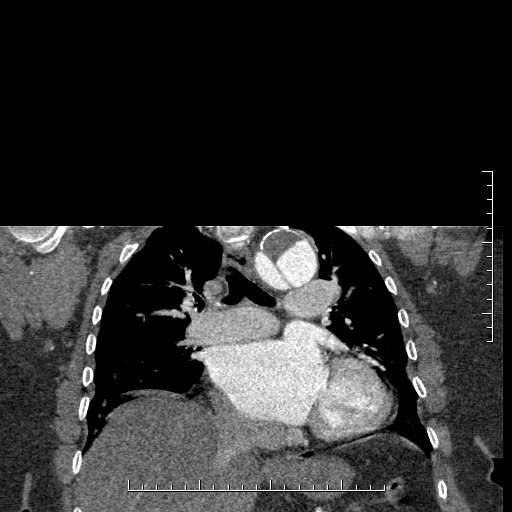 Aortic dissection- Stanford A (Radiopaedia 35729-37268 E 26).jpg