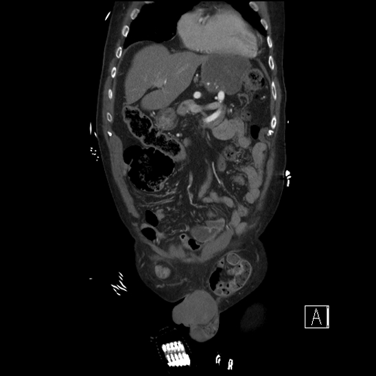 File:Aortic dissection (CTPA) (Radiopaedia 75506-86750 F 16).jpg