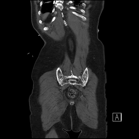 Aortic dissection (CTPA) (Radiopaedia 75506-86750 F 69).jpg