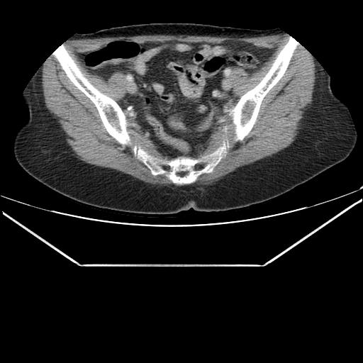 File:Aortic dissection (Radiopaedia 25350-25604 C 89).jpg