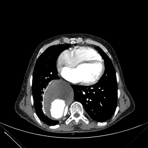 Aortic dissection (Radiopaedia 27466-27665 C+ arterial phase 187).jpg
