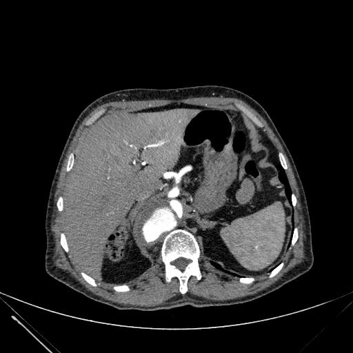 Aortic dissection (Radiopaedia 27466-27665 C+ arterial phase 278).jpg