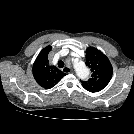 File:Aortic dissection - Stanford A -DeBakey I (Radiopaedia 28339-28587 B 2).jpg