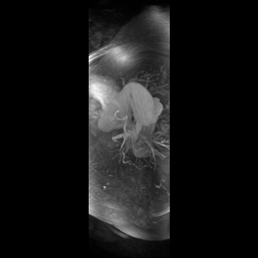 File:Aortic dissection - Stanford A - DeBakey I (Radiopaedia 23469-23551 D 10).jpg