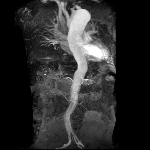 File:Aortic dissection - Stanford A - DeBakey I (Radiopaedia 23469-23551 MRA 2).jpg