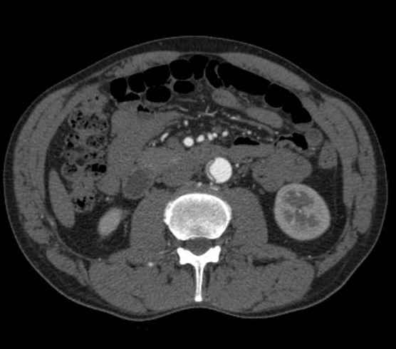 File:Aortic dissection - Stanford type B (Radiopaedia 73648-84437 A 160).jpg