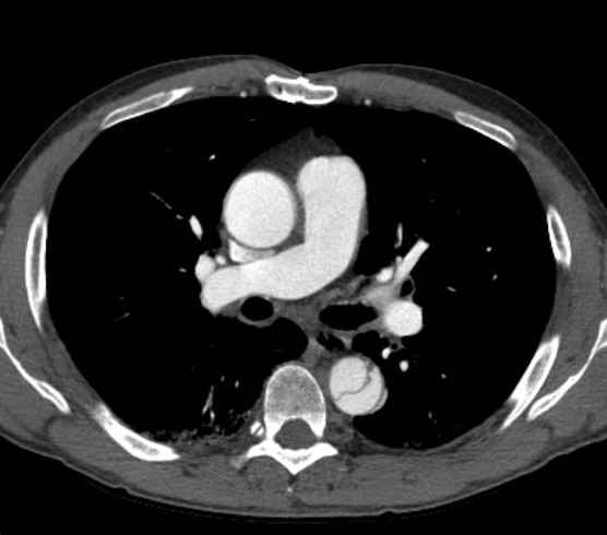 Aortic dissection - Stanford type B (Radiopaedia 73648-84437 A 46).jpg
