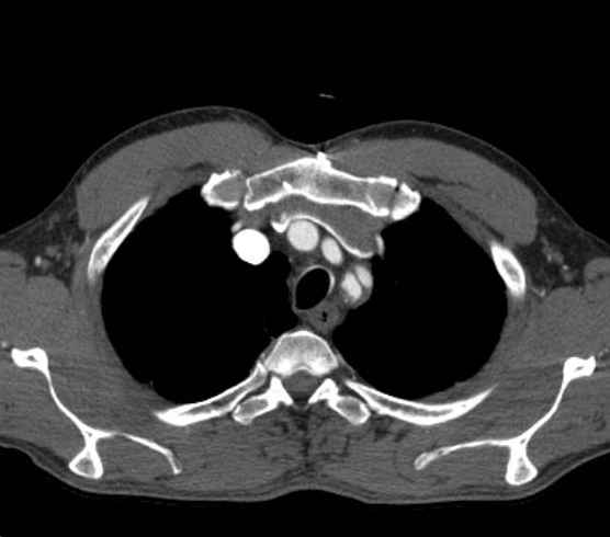 Aortic dissection - Stanford type B (Radiopaedia 73648-84437 A 7).jpg
