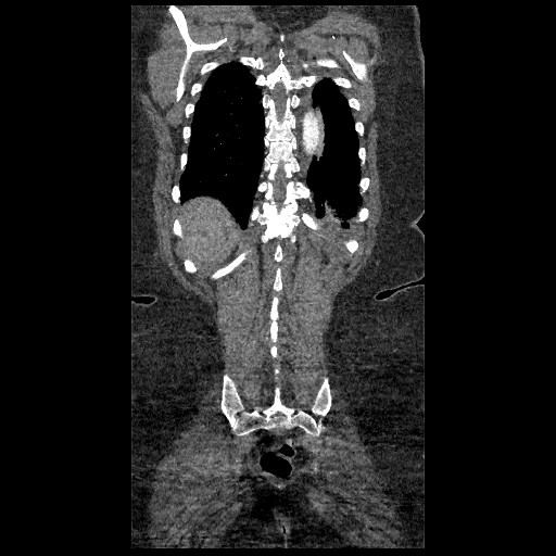File:Aortic dissection - Stanford type B (Radiopaedia 88281-104910 B 77).jpg