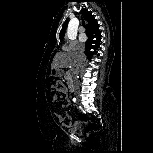 File:Aortic dissection - Stanford type B (Radiopaedia 88281-104910 C 33).jpg