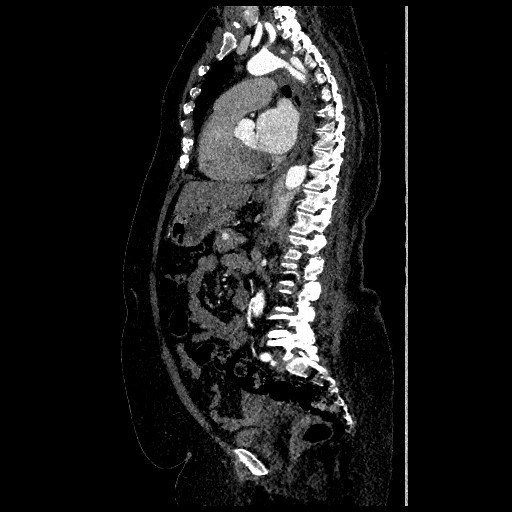 File:Aortic dissection - Stanford type B (Radiopaedia 88281-104910 C 45).jpg