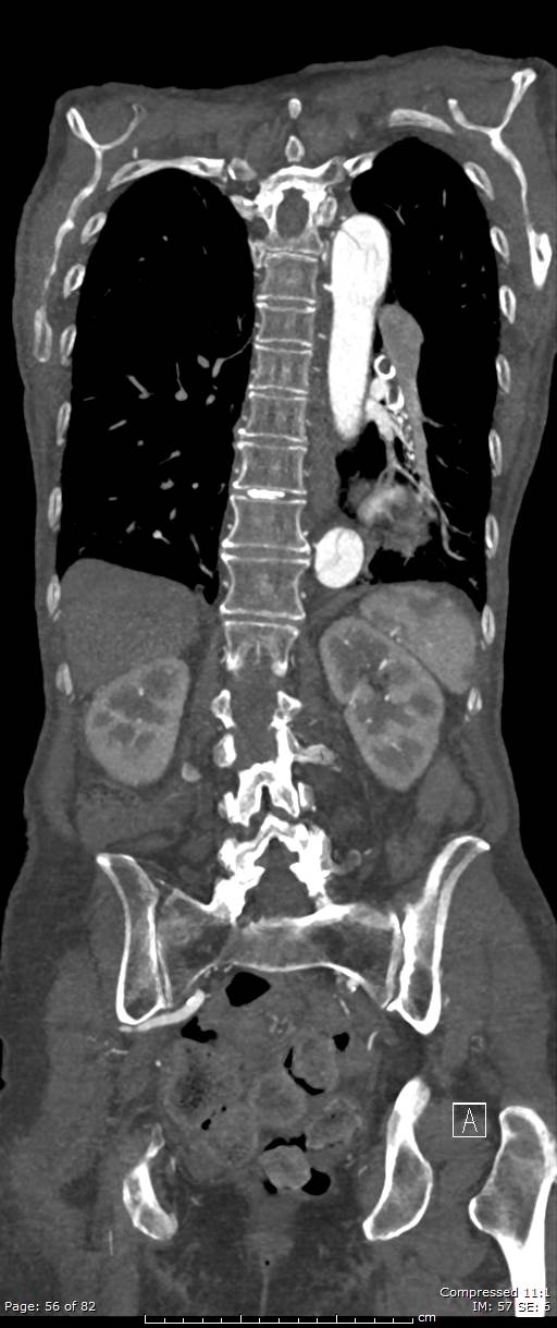 Aortic dissection with extension into aortic arch branches (Radiopaedia 64402-73204 A 56).jpg
