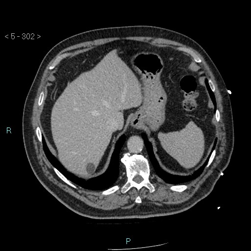 Aortic intramural hematoma (Radiopaedia 48463-53380 C 136).jpg