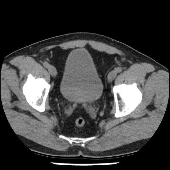 Aortic intramural hematoma (type B) (Radiopaedia 79323-92387 Axial non-contrast 106).jpg