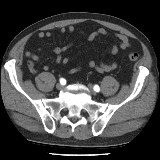 Aortic intramural hematoma (type B) (Radiopaedia 79323-92387 B 93).jpg