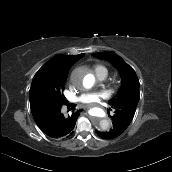 File:Aortic intramural hematoma with dissection and intramural blood pool (Radiopaedia 77373-89491 B 65).jpg