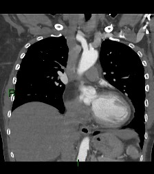 Aortic valve endocarditis (Radiopaedia 87209-103485 D 39).jpg