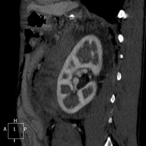 File:Aorto-left renal vein fistula (Radiopaedia 45534-49628 C 50).jpg