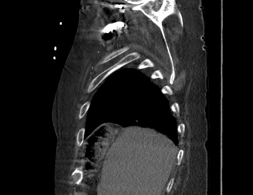 Aortoesophageal fistula with endovascular repair (Radiopaedia 73781-84592 Sagittal C+ CTPA 22).jpg