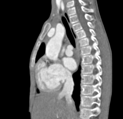 File:Aortopulmonary window, interrupted aortic arch and large PDA giving the descending aorta (Radiopaedia 35573-37074 C 10).jpg