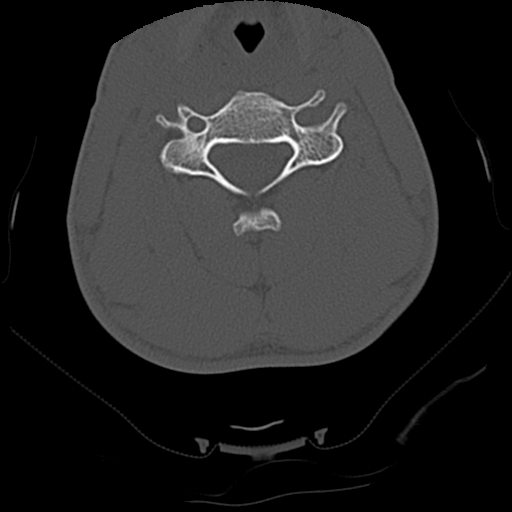 Apical pneumothorax on cervical spine CT (Radiopaedia 45343-49368 Axial bone window 50).jpg