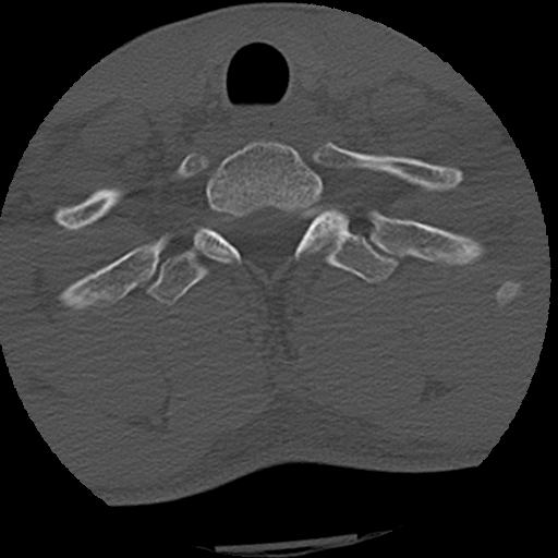 Apical pneumothorax on cervical spine CT (Radiopaedia 45343-49368 Axial bone window 81).jpg
