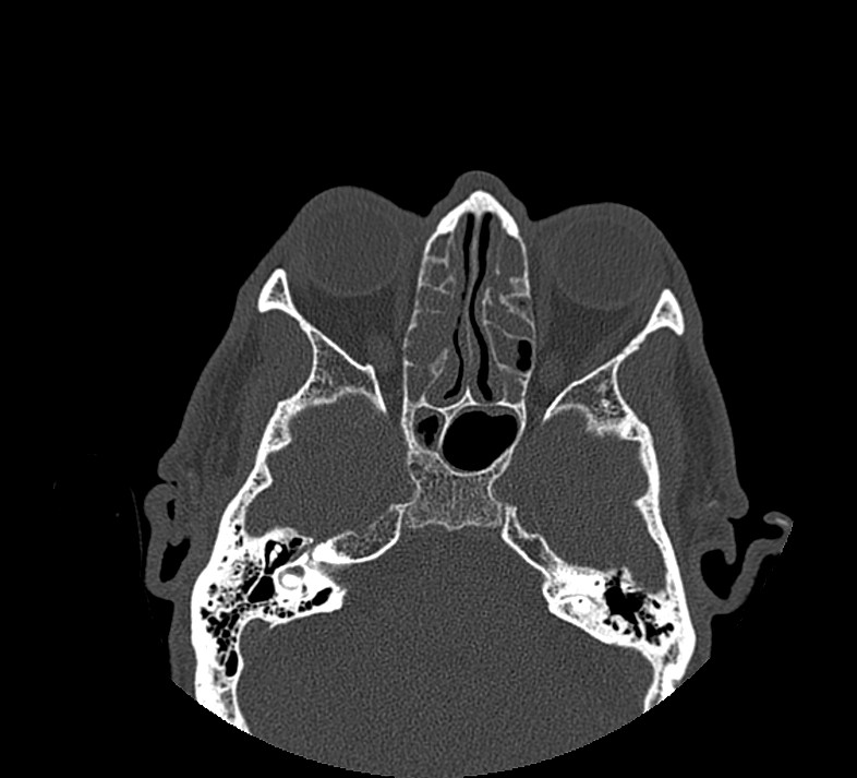 Aplastic maxillary sinuses (Radiopaedia 60030-67561 Axial non-contrast 45).jpg