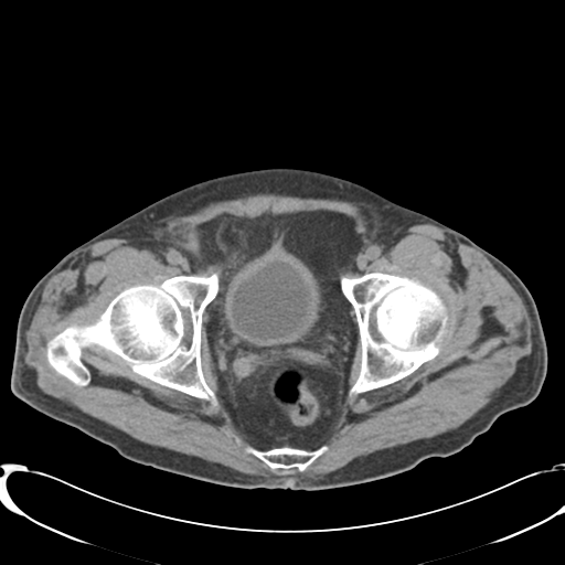 File:Appendiceal abscesses (Radiopaedia 50999-56542 Axial non-contrast 76).png