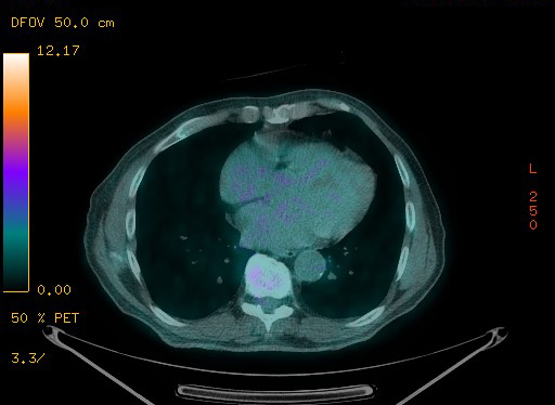 Appendiceal adenocarcinoma complicated by retroperitoneal abscess (Radiopaedia 58007-65041 Axial PET-CT 81).jpg