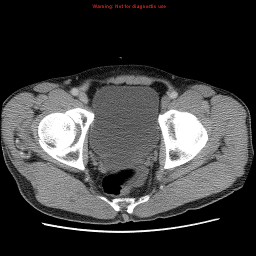Appendicitis and renal cell carcinoma (Radiopaedia 17063-16760 A 53).jpg