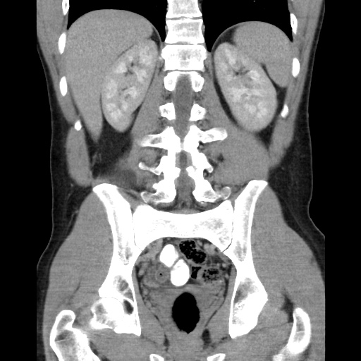 File:Appendicitis complicated by post-operative collection (Radiopaedia 35595-37113 B 38).jpg