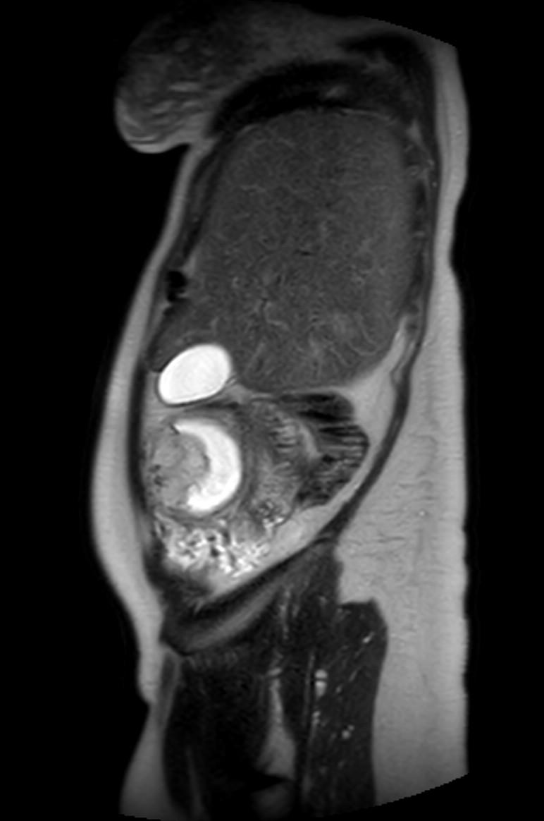 Appendicitis in gravida (MRI) (Radiopaedia 89433-106395 Sagittal T2 54).jpg