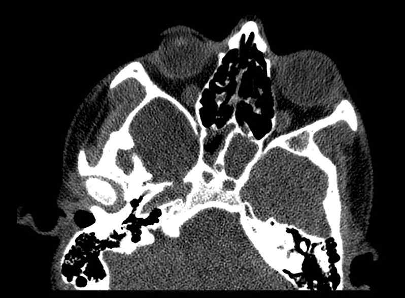 Arachnoid cyst- extremely large (Radiopaedia 68741-78450 Axial bone window 12).jpg