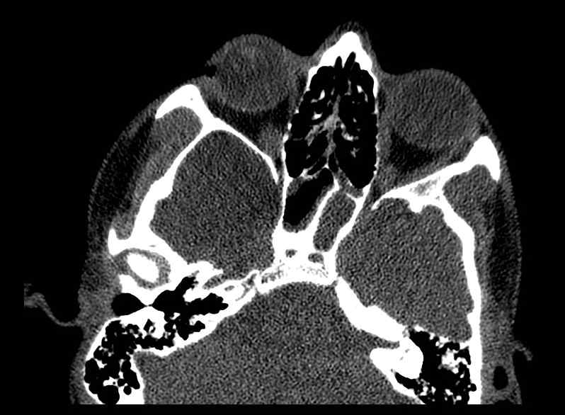 Arachnoid cyst- extremely large (Radiopaedia 68741-78450 Axial bone window 15).jpg