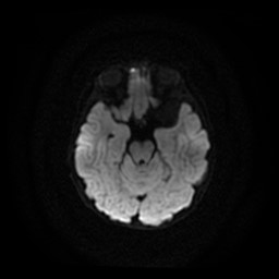 Arachnoid cyst - middle cranial fossa (Radiopaedia 86780-102938 Axial DWI 19).jpg